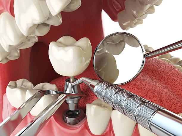 Best Emergency Tooth Extraction in Macdonnell Heights, NY
